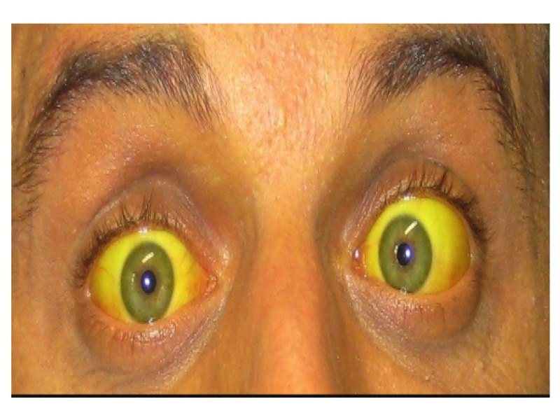 Желтуха причины