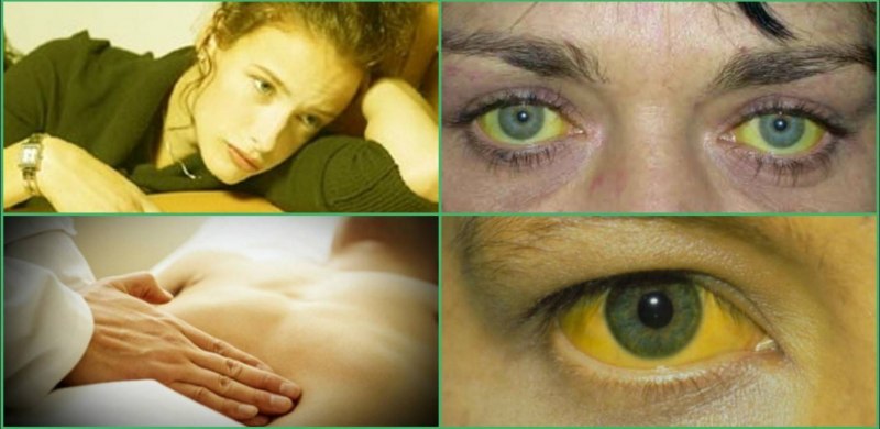 Синдром Жильбера желтуха