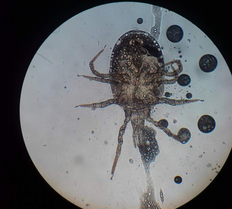 Клещ Энцефалитный в коже