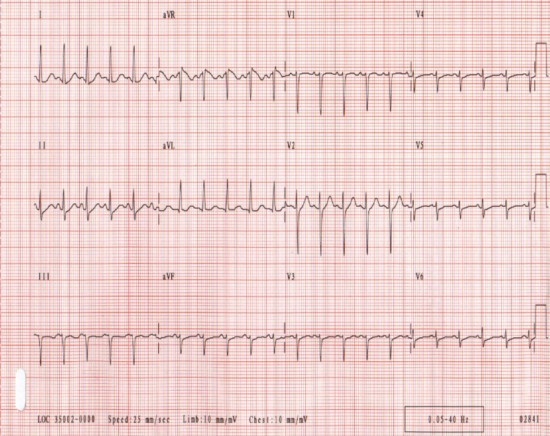 Желудочковая тахикардия с узкими комплексами QRS