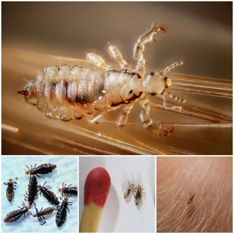 Педикулез вызванный Pediculus humanus capitis