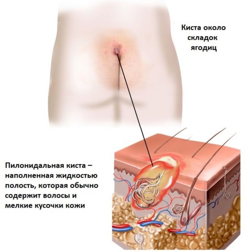 Нагноившаяся копчиковая киста