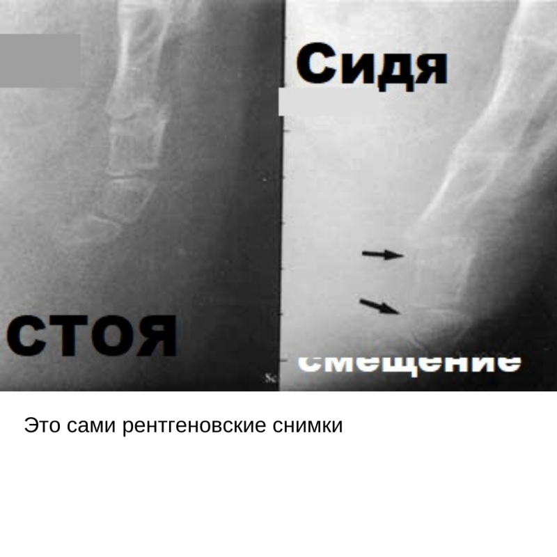 Загиб копчика кпереди симптомы