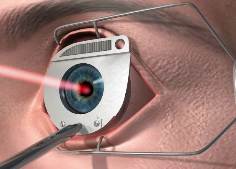LASIK лазерный кератомилез