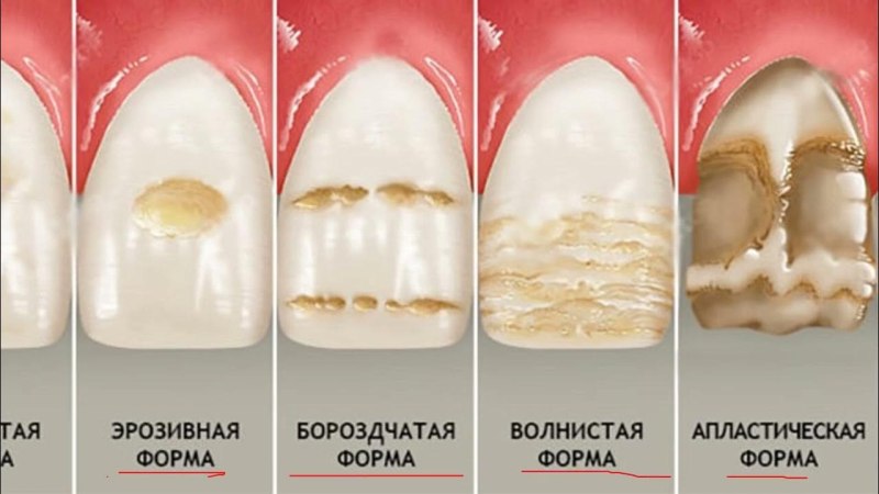 Гипоплазия эмали пятнистая форма