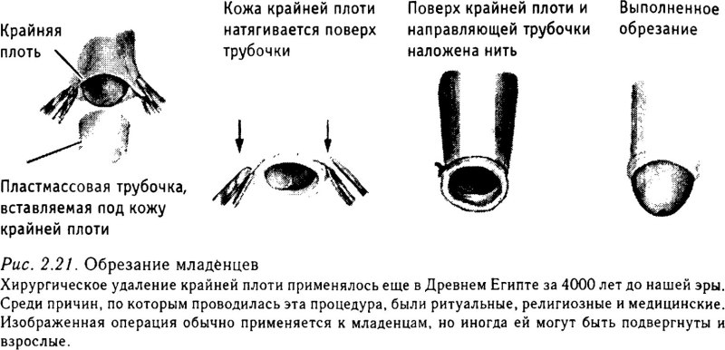 Обрезание у мужчин схема